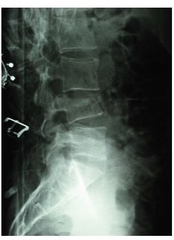 An x-ray image of the spine showing a fracture of the pars