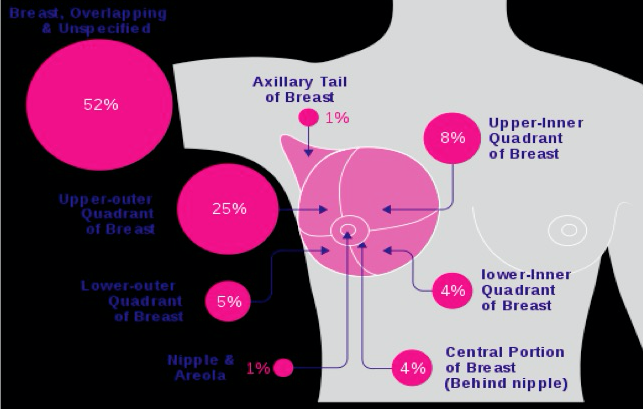 locations of breast cancer occurrences graphic 