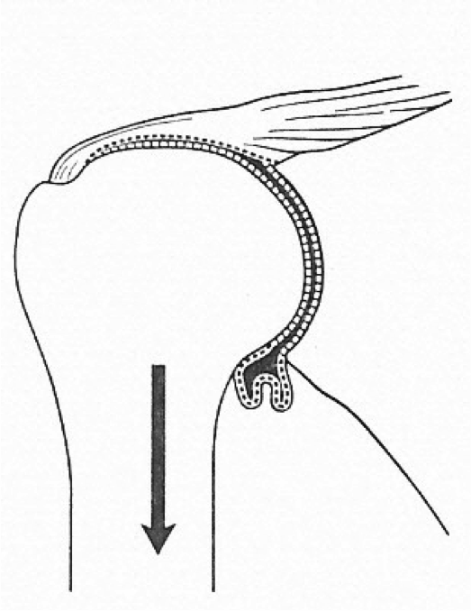 An anatomical line drawing of the right shoulder with adhesive capsulitis
