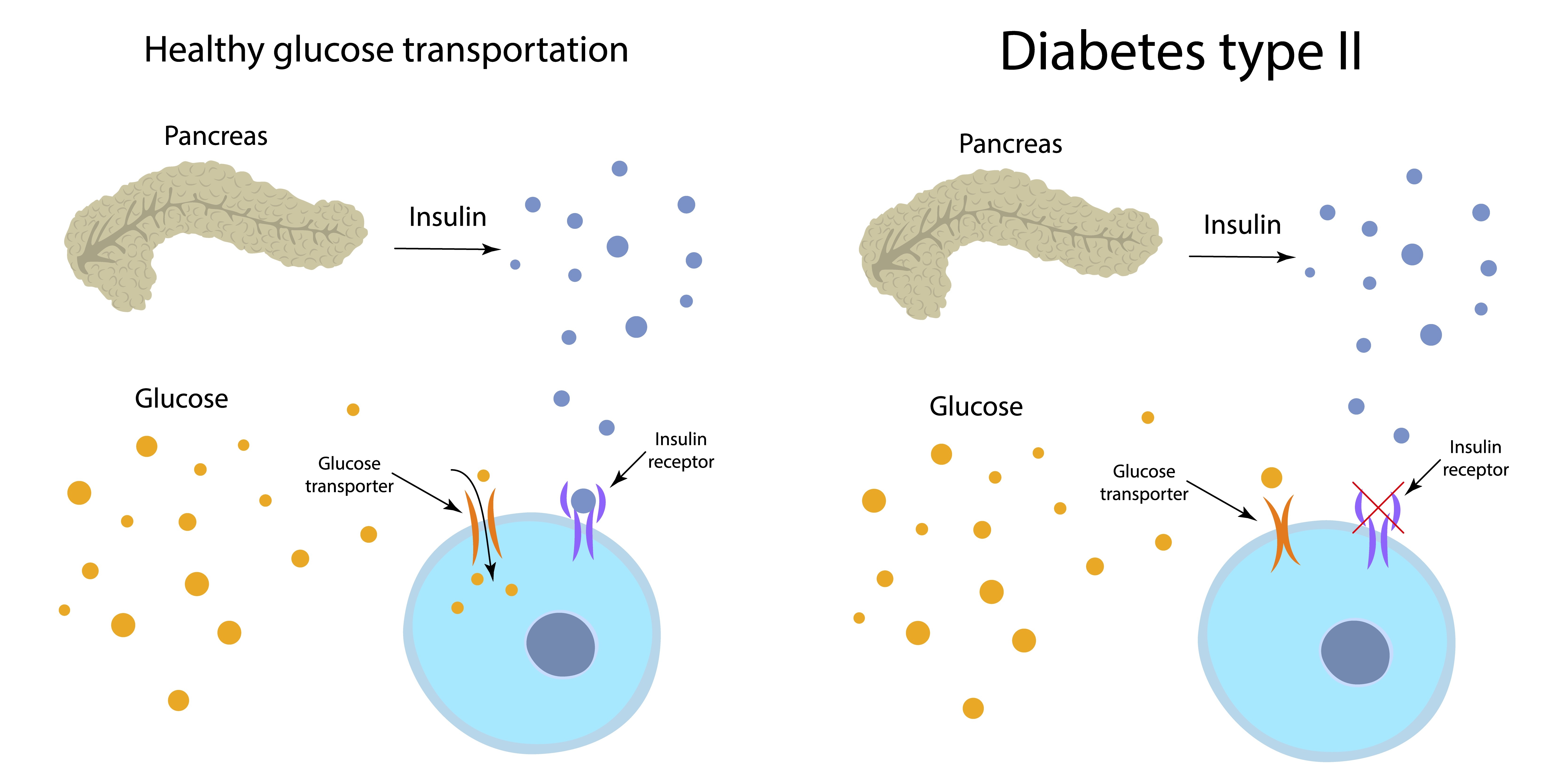 A comparative medical illustration showing how insulin successfully triggers receptors to let glucose into a cell in healthy metabolism, contrasted with Type II diabetes where receptor resistance leaves the glucose transporter closed.